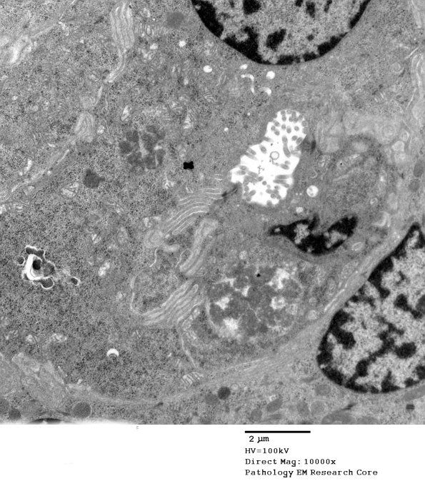 9A5A NCL (Case 9) Skin Bx EM 117A - Copy