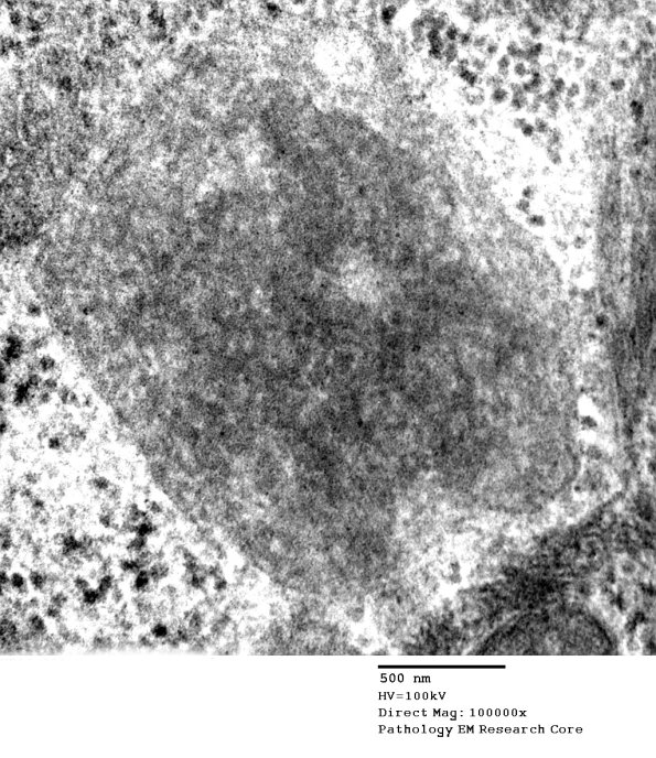 9A7 NCL (Case 9) Skin Bx EM 153A - Copy