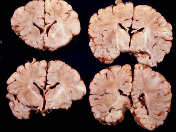 1A Pompe Disease (Case 1) 2