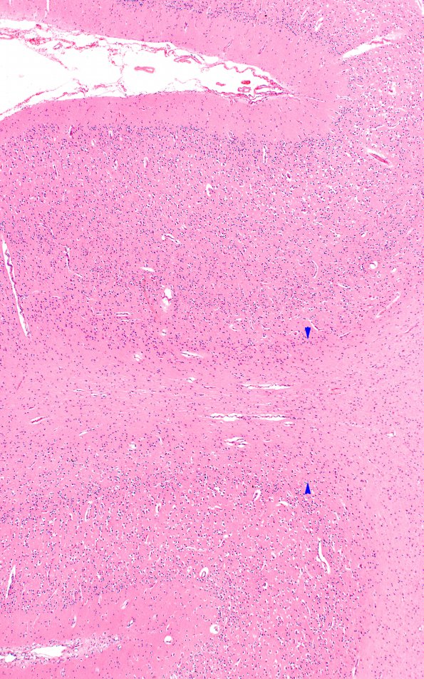 1B1 Pompe Disease (Case 1) Cortex 4X 1A copy