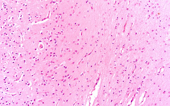 1B4 Pompe Disease (Case 1) Cortex 20X 2A