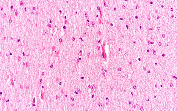 1B5 Pompe Disease (Case 1) Cortex WM 1