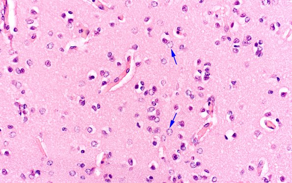 1C Pompe Disease (Case 1) Caudate 1 copy