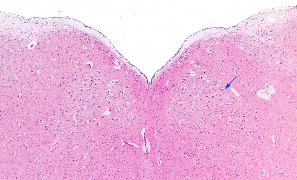 1D1 Pompe Disease (Case 1) XII Nuclei 4X copy