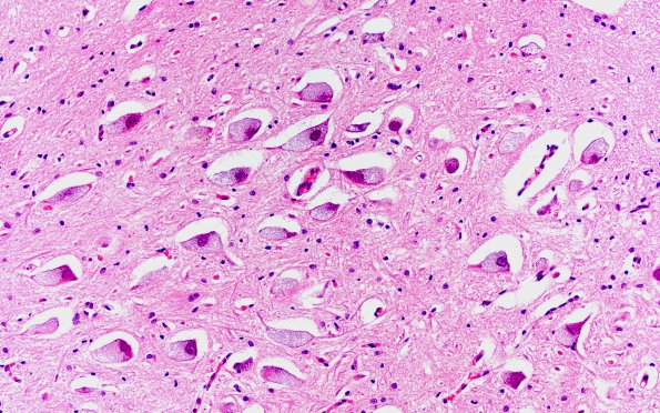 1D2 Pompe Disease (Case 1) XII Nuclei 4