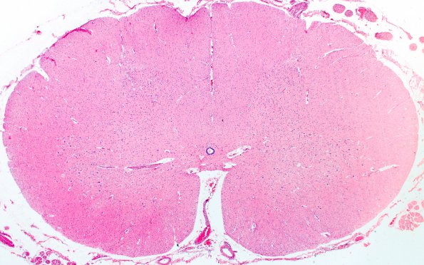 1E1 Pompe Disease (Case 1) Spinal cord 2X 2A