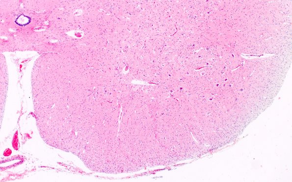 1E2 Pompe Disease (Case 1) Spinal cord 4X