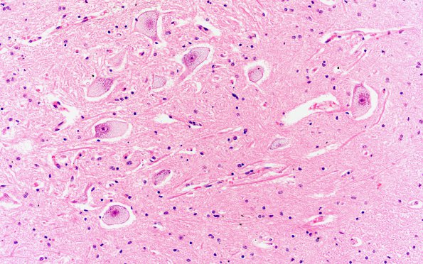 1E3 Pompe Disease (Case 1) Spinal cord 20X 4