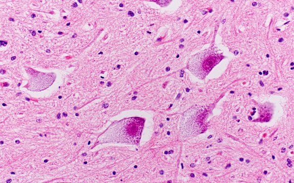 1E4 Pompe Disease (Case 1) Spinal cord 40X