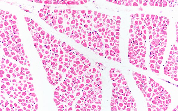 1F1 Pompe Disease (Case 1) Muscle 2