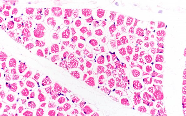 1F2 Pompe Disease (Case 1) Muscle 1