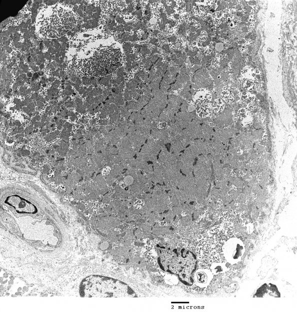 2C1 Pompe Dz (Case 2) EM 8 - Copy