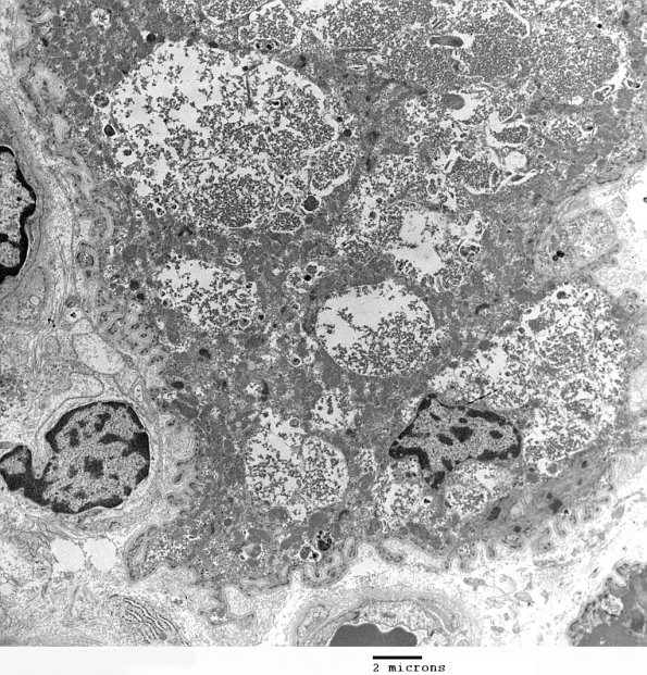 2C2 Pompe Dz (Case 2) EM 2 - Copy