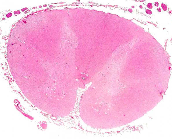 3A1 Pompe Dz (AANP 1964, Case 1) H&E 1.2X 4