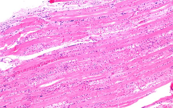 5A1 Muscle (Case 5) H&E 10X