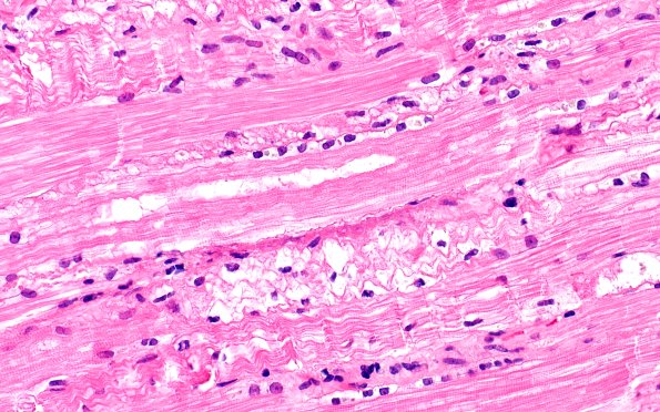 5A2 Muscle (Case 5) H&E 40X
