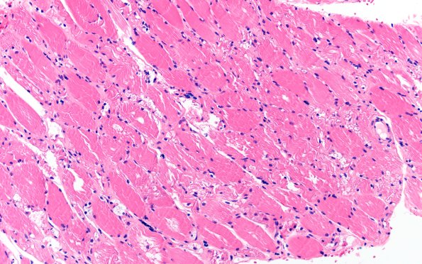 5A3 Muscle (Case 5) H&E 20X