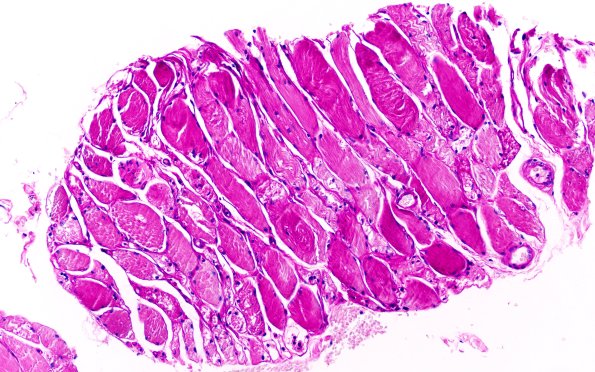 5B1 Muscle (Case 5) PAS 20X