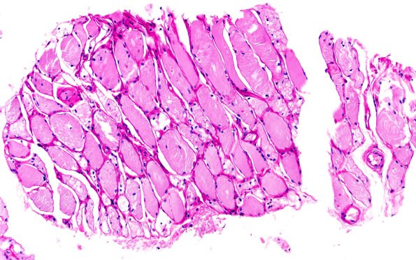 5B2 Muscle (Case 5) PAS with diastase 20X