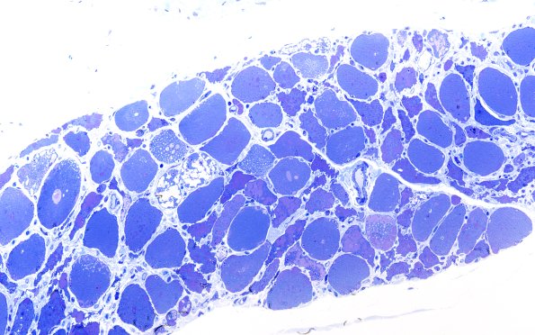 5C1 Muscle (Case 5) Plastic 100X 1