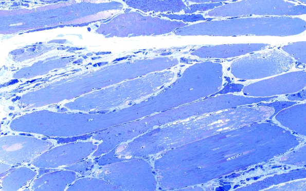 5C2 Muscle (Case 5) Plastic 20X 1