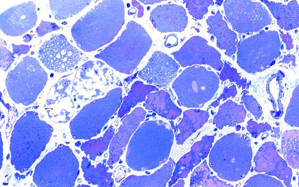 5C6 Muscle (Case 5) Plastic 40X 1