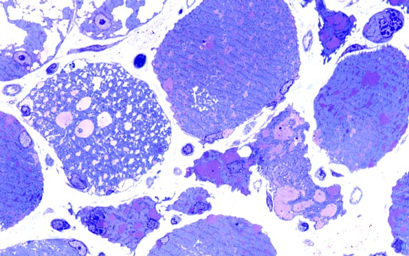 5C7 Muscle (Case 5) Plastic 100X 5