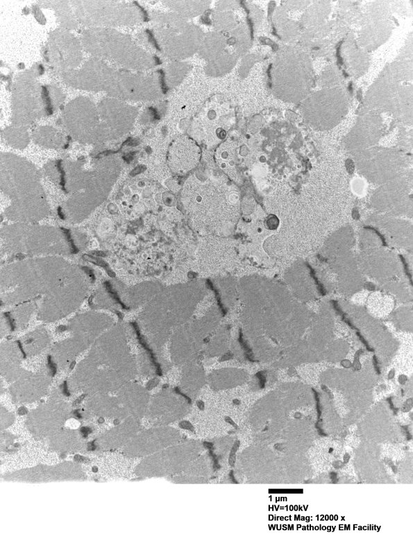 5D11 Muscle (Case 5) EM022 - Copy