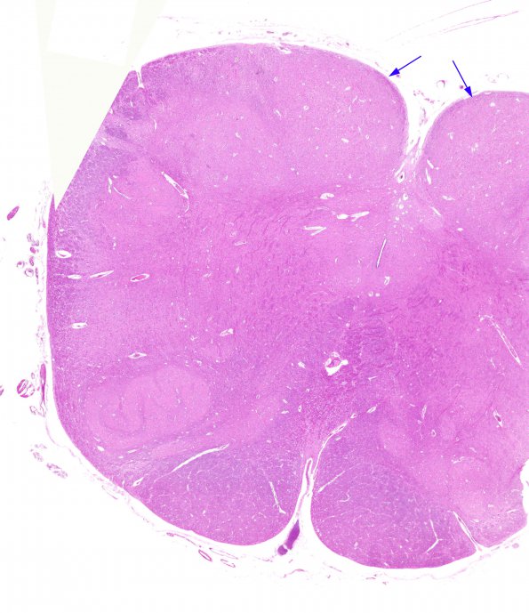 1A1 Vitamin E Deficiency (Biliary atresia, Case 1) N8 H&E whole mount copy copy