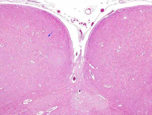 1A2 Vitamin E Deficiency (Biliary atresia, Case 1) H&E 1 copy