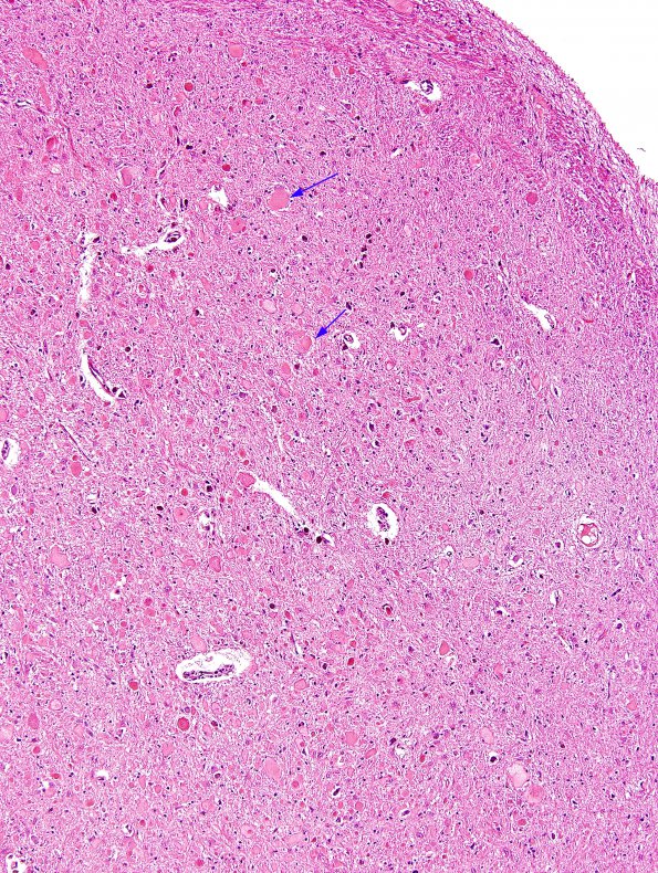 1A3 Vitamin E Deficiency (Biliary atresia, Case 1) H&E 2 copy