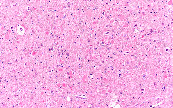 1A4 Vitamin E Deficiency (Biliary atresia, Case 1) N8 H&E 4