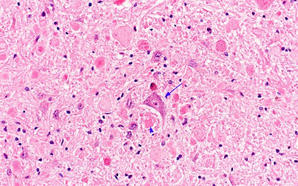 1A5 Vitamin E Deficiency (Biliary atresia, Case 1) N8 H&E 1 copy