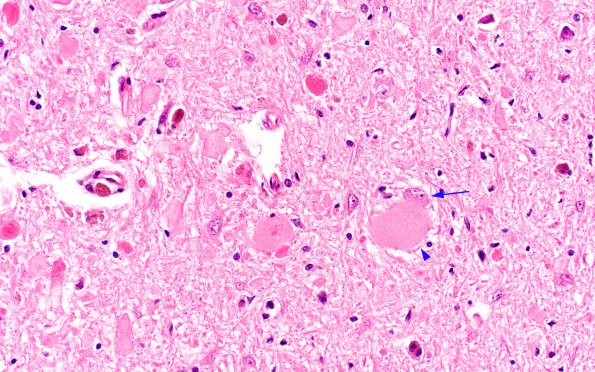 1A6 Vitamin E Deficiency (Biliary atresia, Case 1) N8 H&E 7 copy