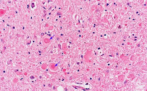 1A7 Vitamin E Deficiency (Biliary atresia, Case 1) N8 H&E 3 copy