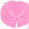 1C1 Vitamin E Deficiency (Biliary atresia, Case 1) Clarke's column H&E 9 copy