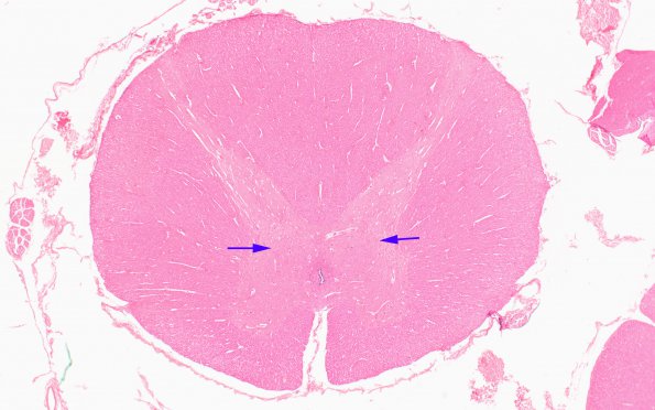 1C1 Vitamin E Deficiency (Biliary atresia, Case 1) Clarke's column H&E 9 copy