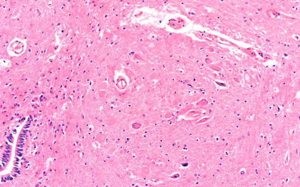 1C2 Vitamin E Deficiency (Biliary atresia, Case 1) Clarke's column H&E 3