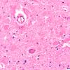 1C3 Vitamin E Deficiency (Biliary atresia, Case 1) Clarke's column H&E 2