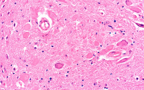 1C3 Vitamin E Deficiency (Biliary atresia, Case 1) Clarke's column H&E 2