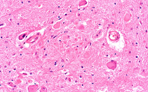 1C4 Vitamin E Deficiency (Biliary atresia, Case 1) Clarke's column H&E 5