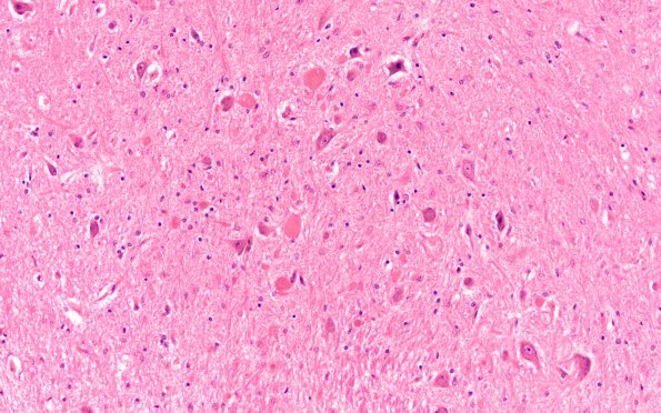 1D Vitamin E Deficiency (Biliary atresia, Case 1) Vestibular nucleus H&E