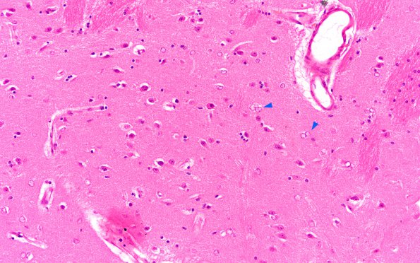 1E Vitamin E Deficiency (Biliary atresia, Case 1) N2 H&E 1 copy