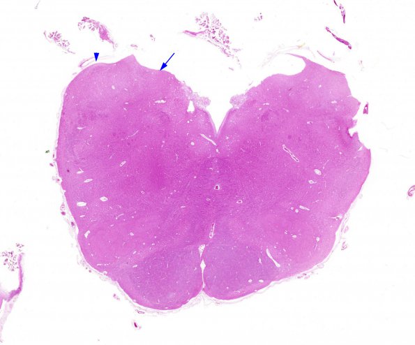 2A Vitamin E Deficiency (Biliary atresia, Case 2) Medulla H&E whole mount A