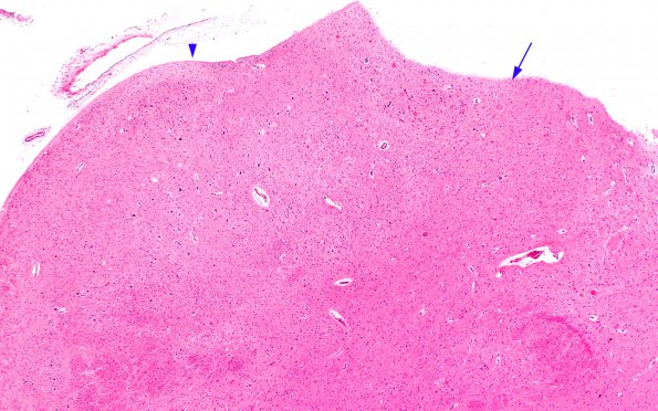 2A2 Vitamin E Deficiency (Biliary atresia, Case 2) Medulla H&E gracile 3 copy A