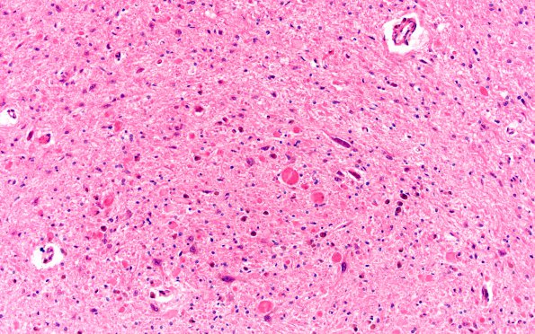 2A3 Vitamin E Deficiency (Biliary atresia, Case 2) Medulla H&E gracile 2A