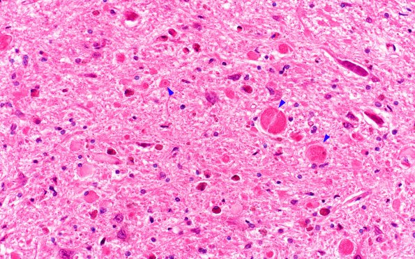 2A4 Vitamin E Deficiency (Biliary atresia, Case 2) Medulla H&E gracile 1A copy