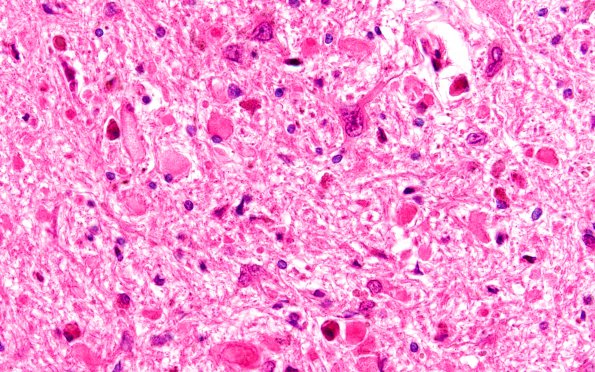 2A5 Vitamin E Deficiency (Biliary atresia, Case 2) Medulla H&E gracile 1A