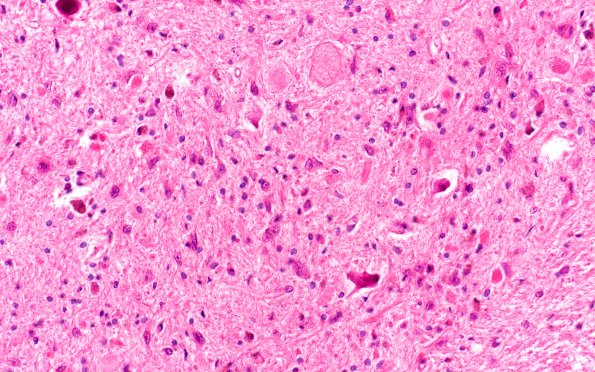 2A7 Vitamin E Deficiency (Biliary atresia, Case 2) Medulla H&E cuneate-lat cuneate 1AAA