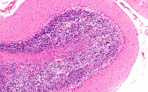 2B1 Vitamin E Deficiency (Biliary atresia, Case 2) Cerebellum H&E 2 A